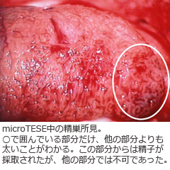 micro-TESE中の精巣所見