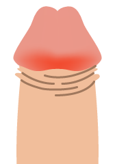 嵌頓包茎